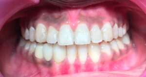 Alt="dental occlusion"