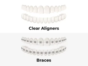 Alt = "Braces Aligners"