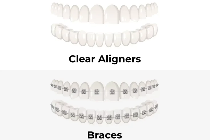 Alt = "Braces Aligners"