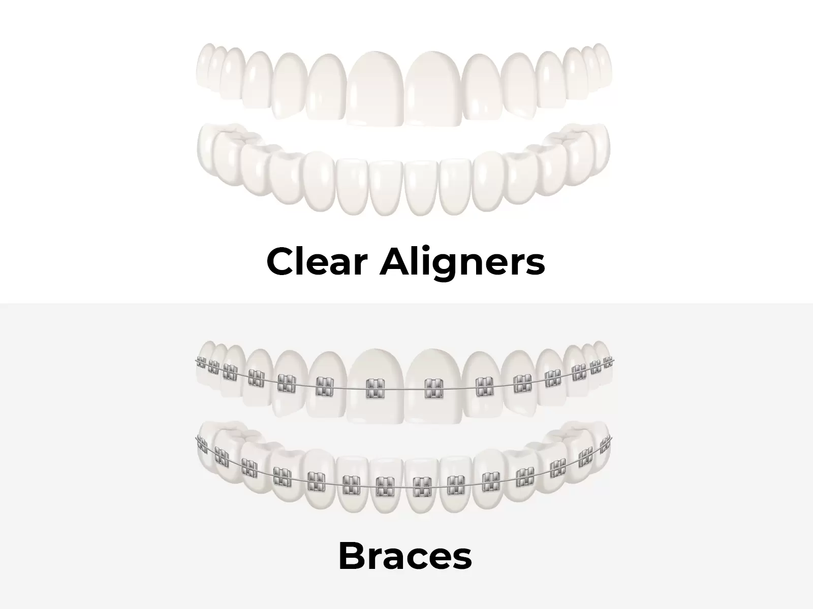 Alt = "Braces Aligners"