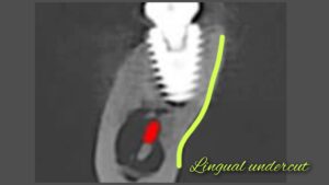 Alt="lingual concavity"