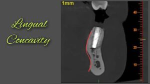 Alt="lingual concavity"