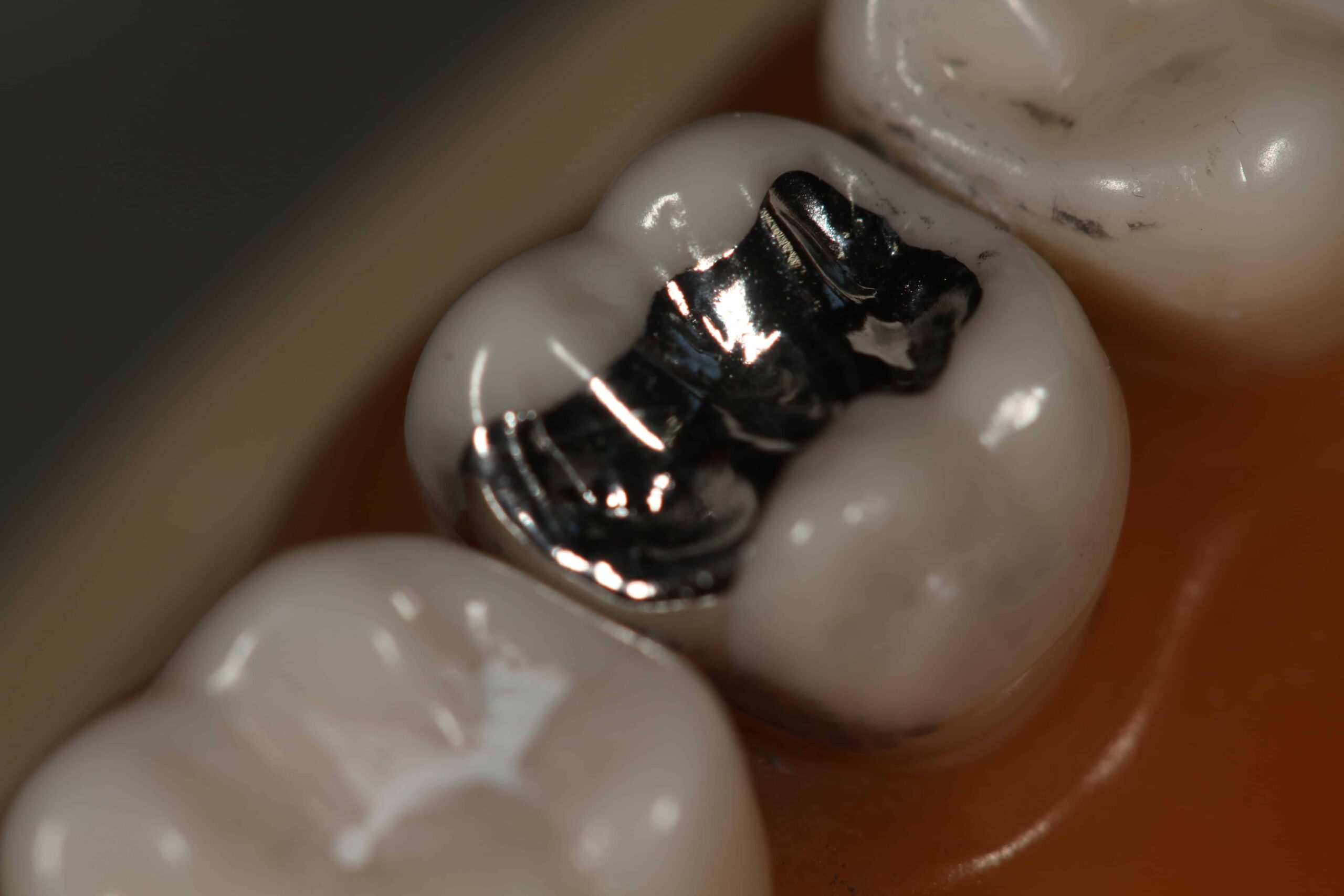 Alt="silver amalgam"